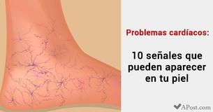 Problemas cardíacos: 10 señales de advertencia que tal vez aparezcan en tu piel