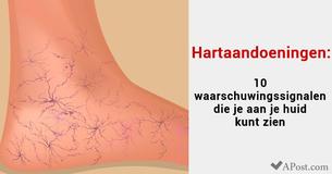 Hartaandoeningen: 10 waarschuwingssignalen die je aan je huid kunt zien