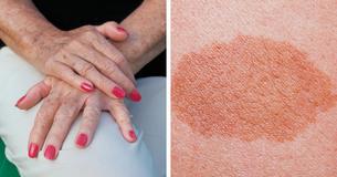 The 11 Best Way To Remove Dark Spots And Get Flawless Skin