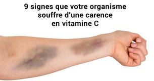 9 signes indiquant que votre corps souffre d'une carence en vitamine C