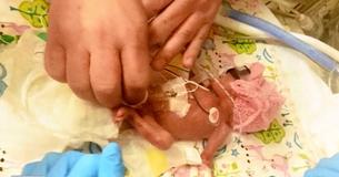 O menor bebê prematuro de todos desafia as probabilidades e vence - veja como ela está agora