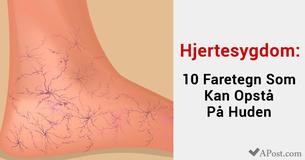 Hjertesygdom: 10 Faretegn Som Kan Opstå På Huden