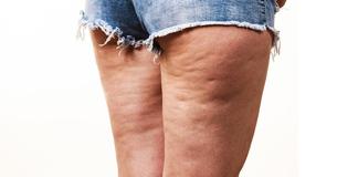 6 simpele oefeningen om binnen 2 weken van cellulitis af te komen