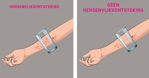 8 herkenbare signalen van hersenvliesontsteking