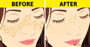 7 Old-Fashioned Tips That Will Make Acne Scars And Skin Imperfections A Thing Of The Past