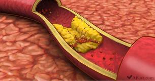 Updated Cholesterol Guidelines To Promote Heart Health: What You Must Know