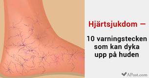 Hjärtsjukdom — 10 varningstecken som kan dyka upp på huden