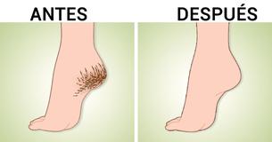 Elimina los callos causados por tus zapatillas con ESTOS remedios caseros