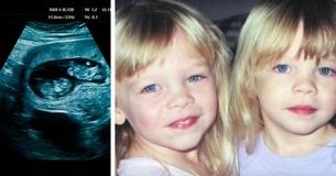 Des parents trouvent l'une de leur jumeau identique  effondrée sur le sol de la la salle de bains -  Le docteur trouve un 'enchevêtrement' dans son cerveau.