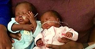 Une mère accouche de jumeaux, mais veut que le médecin en laisse un dans son ventre pour lui sauver la vie