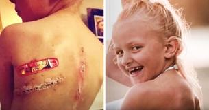 Une Maman a eu une belle réaction après que le garçon ait demandé à sa fille de couvrir les cicatrices du cancer