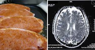 Un adolescent fait des crises et meurt après que les médecins ont découvert des oeufs de ténias dans le cerveau. Une erreur mortelle suite à la consommation de porc mal cuit  