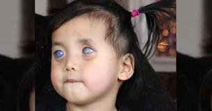 Le diagnostic ultra rare d'une fille adoptée a entraîné l'ablation de ses yeux " argentés "