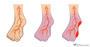7 choses que tu dois commencer à faire si tu souffres d'hypertension artérielle, de varices ou d'AVC