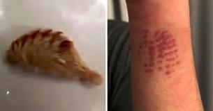 Un ragazzino nota uno sfogo doloroso a forma di reticolo sul braccio, e sua mamma scopre che è stato causato da un bruco velenoso