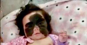 La mère d'une fille avec une tache de naissance comme "Le masque de Batman" s'ouvre sur l'intimidation que sa fille se fait subir par des étrangers.