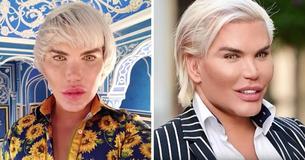 Le nez de Ken , la poupée version humaine, commence à fondre après son 11e rhinoplastie.