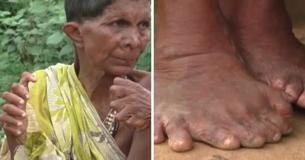 Une femme née avec 19 orteils et 12 doigts en Inde affirme qu'elle n'est pas capable de sortir à l'extérieur en entrevue