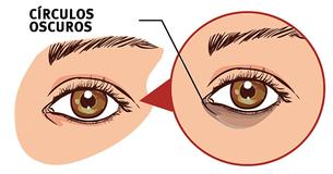 5 métodos naturales para eliminar círculos oscuros debajo de los ojos