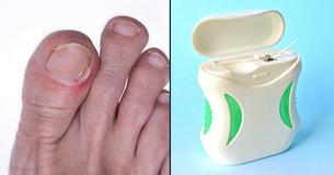 Uñas encarnadas: 6 remedios caseros que son sorprendentemente efectivos