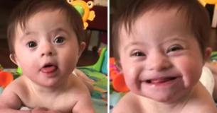 Baby mit Down-Syndrom wird berühmt, nachdem es seiner Adoptivmutter sein "neues Lächeln" zeigte