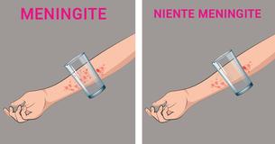 8 segni riconoscibili di meningite