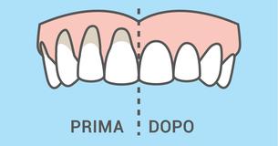 10 metodi semplici e naturali per curare la recessione gengivale