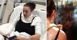 Vittima di ustione si toglie le bende e rimane stupefatta dalla reazione di un orango alle sue ferite
