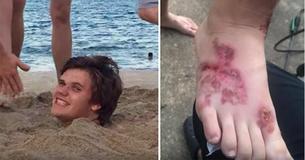 Un ragazzino contrae un'infezione da anchilostomi ai piedi dopo che si è fatto seppellire nella sabbia