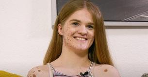 Girl Born With Dozens Of Birthmarks Is Bullied Because Of Her Appearance For Years - Becomes A Model