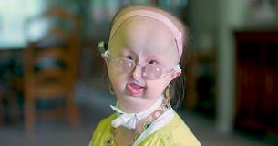 Woman Born With Rare Disorder Is Commonly Mistaken For A Child But Maintains Positive Outlook