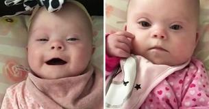 En un caso extremadamente raro, dos hermanas gemelas nacen con síndrome de Down