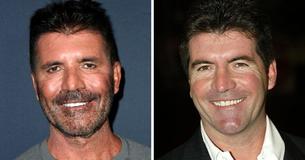 Simon Cowell hat aufgehört, Filler zu verwenden, nachdem sein Sohn wegen seines verpfuschten Äußeren hysterisch wurde