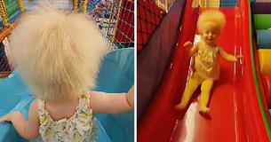 Toddler Born With Rare Hair Syndrome Is One Of Roughly 100 Confirmed Cases Worldwide
