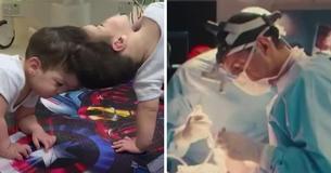 Conjoined Twins, 3, Are Separated In Historic Surgery That Utilized Virtual Reality
