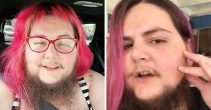Woman Struggling With Excess Facial Hair Now Loves Her Beard