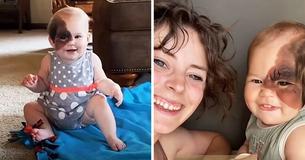 Mom Hopes To Show That ‘Differences’ Are Beautiful By Sharing Daughter’s Rare Birthmark