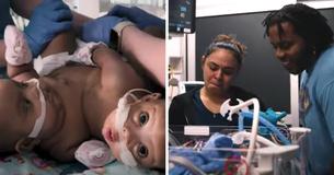 Conjoined Twins Successfully Separated In ‘Rare’ and ‘Groundbreaking’ Surgery