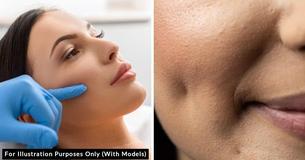 Mom Splurged On $1,500 Procedure To Have Fake Dimples Stitched In Her Face