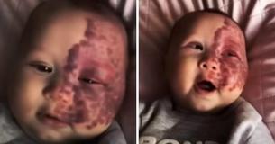 Une mère se fait critiquer pour avoir passé au laser une tache de vin de son enfant, causée par un problème médical, bien qu'elle ait pris la bonne « décision »
