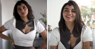 Woman Bullied & Called 'Dalmatian' Because Of Her Birthmarks Refuses Surgery