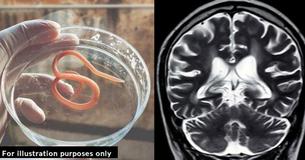 Doctors Dumbfounded At ‘Once-In-A-Career Finding’ After 3-Inch Worm Was Discovered In Patient’s Brain