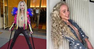 Woman Admits She Regrets Spending $165,000 On Leg Extension Surgery That Made Her Taller By 5.5 Inches