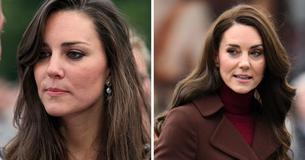 Kate Middleton's Health History — From Mysterious Head Scar To Hospitalization Due To Abdominal Surgery