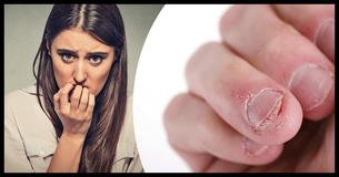 Nail-Biting Isn't Just a Bad Habit - It's a Health Hazard
