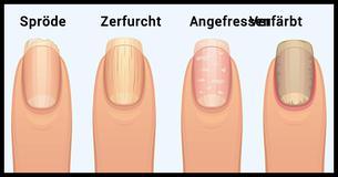 Die schockierende Wahrheit, die Fingernägel über Deine  Gesundheit offenbaren 
