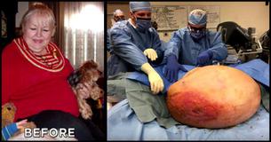 Mom Thinks She’s Gaining Weight With Age Until Doctors Remove 140-Pound Ovarian Cyst