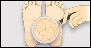 How To Use Baking Soda As A Treatment For Calluses, Foot Odor, And Cracked Heels