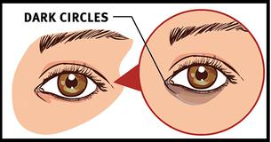 5 Natural Methods To Remove Dark Circles Under Your Eyes