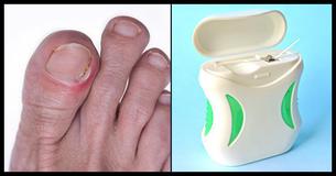 Ingegroeide Teennagels: 6 Huismiddeltjes Die Verrassend Effectief Zijn